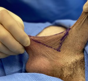 Est-ce que la chirurgie de correction de palmure scrotalee  (en anglais penoscrotal webbing) est pratiqué en Tunisie ?
Il s’agit d’une condition ou la peau du scortum s’étend trop haut sur la surface inférieur du pénis  formant une sorte de plis cutanées